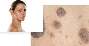 Melanoma-or-Age-Spots-How-to-Tell-the-Difference Platinum Delux ®